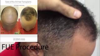 FUE Hair Transplant  3000 Grafts  Dr Rob Jones  Toronto CA Hair Transplant Doctor [upl. by Medor356]