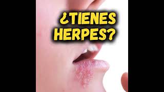 ¿TIENES HERPES 🧏🏻‍♀️ [upl. by Feltie50]