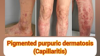 PIGMENTED PURPURIC DERMATOSIS capillaritis पैरों में काले भूरे या लाल धब्बे प्रकार कारण और उपचार [upl. by Abigael626]