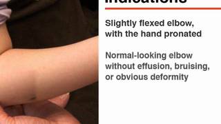 Reduction of Pulled Elbow [upl. by Niwled107]