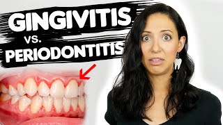 Do You Have Gingivitis or Periodontitis  Different Stages Of Gum Disease [upl. by Yevol]