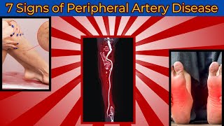 Peripheral Artery Disease Warning Signs You Shouldnt Ignore [upl. by Damha]