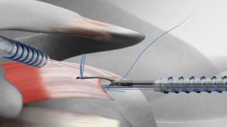 Rotator Cuff Repair with Arthrex® SutureBridge™ [upl. by Elyag]