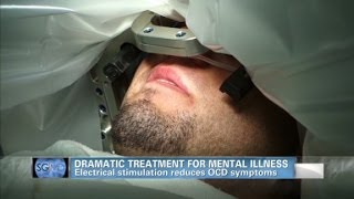 Sanjay Gupta MD Deep brain stimulation helps OCD patient [upl. by Eecyaj]