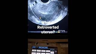 what is Retroverted uterusand how looks on tvs ultrasound [upl. by Yaned]