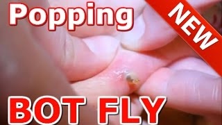 Popping bot fly  Bot fly removal  Botfly removal AAHC [upl. by Lidda]