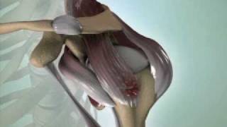 Torn Rotator Cuff Causes Symptoms amp Treatment  DePuy Videos [upl. by Samella]