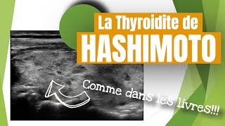 quotPeau de Leopardquot thyroidite de Hashimoto en échographie [upl. by Akeihsal]