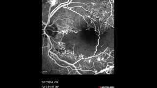 Proliferative Diabetic Retinopathy [upl. by Akeem922]