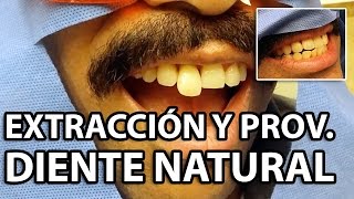 DIENTE NATURAL como PROVISIONAL 👅 FERULIZADO dentaltip dental [upl. by Mattland]