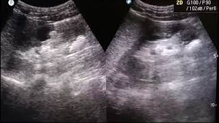 KIDNEY STONES  show multiple calculi  ultrasound usg stone kidney calculi [upl. by Nnahsal]