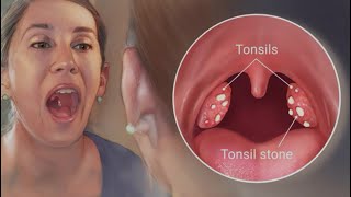 How to get rid of tonsil stones🤮 [upl. by Ahsiner362]