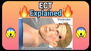 Electroconvulsive therapy ECT explained  How it is performed [upl. by Dlorag515]