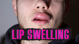 CAUSES OF SWOLLEN LIPS AND HOW TO TREAT [upl. by Iams]