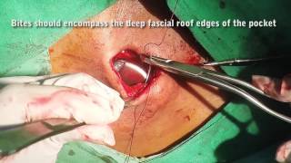 Closure of Pacemaker Pocket  Example 3  Dual Chamber System [upl. by Otilrac]