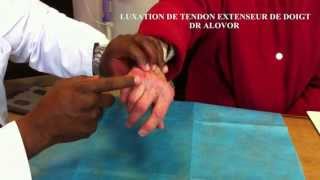 LUXATION DU TENDON EXTENSEUR DE LANNULAIRE [upl. by Canning]