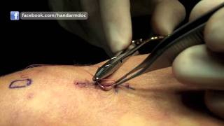 Subcuticular Suture Technique  Hand and Arm Surgery [upl. by Arri122]