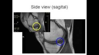 How to Read Knee MRI of Torn Meniscus  Meniscal Tear  Santa Fe Albuquerque Orthopedic Surgeon [upl. by Naillimxam]