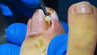 WARNING Dont Try to Remove an Ingrown Toenail Without Watching This [upl. by Hibbs]