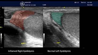 Acute Epididymitis  some PointofCare Ultrasound Features [upl. by Klump]