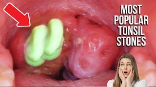 Tonsil Stones amp Removal At Home Compilation  Most Popular [upl. by Anigal]