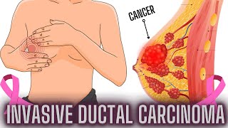 Invasive Ductal Carcinoma What You Need to Know [upl. by Baptlsta]