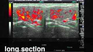 Hashimotos thyroiditisPower Doppler ultrasound [upl. by Ariuqahs]