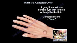 What Is A Ganglion Cyst  Everything You Need To Know  Dr Nabil Ebraheim [upl. by Rachael]