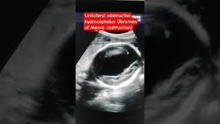 Foramen of Monro obstruction Unilateral hydrocephalus Third and fourth ventricle normal [upl. by Kurys]