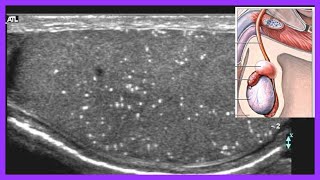 ¿Absceso Testicular o Seminoma [upl. by Eiralih]