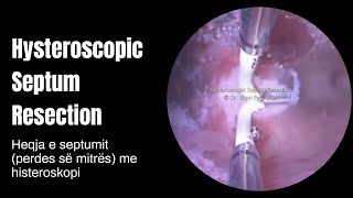 Heqja e perdes së mitrës me histeroskopi – Hysteroscopic Septum Resection Metroplasty [upl. by Acenom]