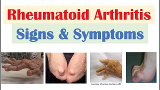 Rheumatoid Arthritis RA Signs amp Symptoms amp Associated Complications [upl. by Htebasyle]