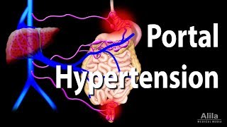 Portal Hypertension Animation [upl. by O'Meara]