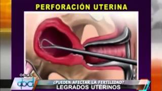 PROCREAR ¿Los legrados uterinos afectan la fertilidad [upl. by Ettennyl]