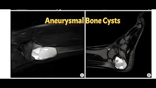 Aneurysmal Bone Cyst  The Bone Thats Alive [upl. by Arthur]