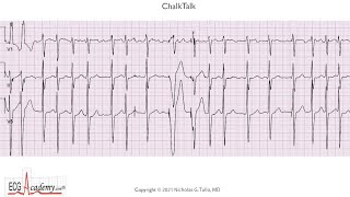 ECG Lesson in Advanced Pacemaker Troubleshooting [upl. by Imekawulo431]