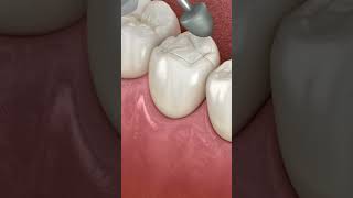 Dental Restoration Composite Bonding Teeth 3D Medical Animation asmr animation shorts trending [upl. by Otxis216]