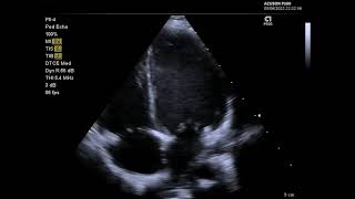 A selection of echocardiography views using the P84 transducer on the Siemens Acuson P500 [upl. by Jackie]