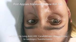 Transformation of Apogeotropic Horizontal Canal BPPV to Geotropic Variant [upl. by Bibby]