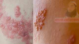 হার্পিস জোস্টার চিকিৎসা ও ঔষধ। Herpes zoster treatment and medicine Viral disease [upl. by Sturdivant]