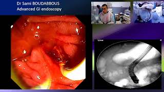 ERCP for acute cholangitis [upl. by Mechelle687]