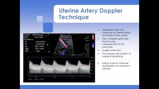 Advanced Fetal Doppler Webinar with Piotr Niznik [upl. by Hagai]