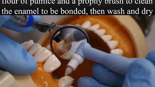 Composite Bonded Bridge  Cementation Technique by Joel N Janis DDS [upl. by Olathe]