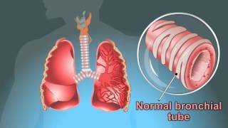 what are the Symptoms Of Tuberculosis [upl. by Repohtsirhc]