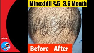 minoxidil 5 before after 35 month [upl. by Etta]