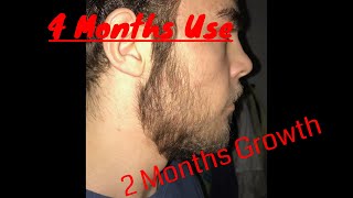 MINOXIDIL BEARD 2 month of GROWTH 4 months of use TIMELAPSE [upl. by Gussi27]