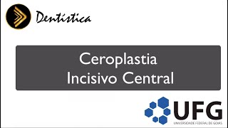 Ceroplastia Incisivo Central Superior [upl. by Nosreh]