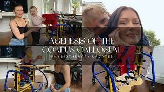 Agenesis of the Corpus Callosum  Physiotherapy Updates [upl. by Delmar]