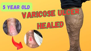 Healed 5 year old ULCER  Best result of Laser treatment  EVLT [upl. by Rafiq]