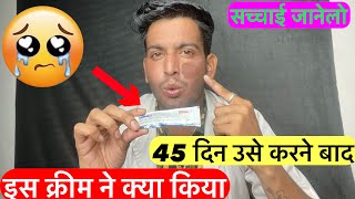 45 दिन उसे करने बाद  Panderm plus cream  Panderm  Panderm plus lagane se kya hota hai [upl. by Haroved926]